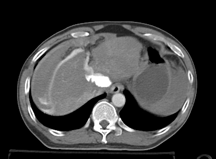 Traumatic liver injury with ruptured intra-hepatic IVC | Radiology Case ...