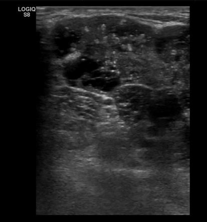 Metastatic papillary carcinoma of the thyroid | Image | Radiopaedia.org