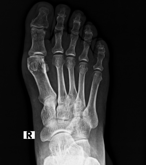 Fracture proximal phalanx of 5th toe Radiology Case