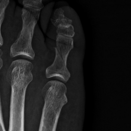 Fracture proximal phalanx of 5th toe | Radiology Case | Radiopaedia.org