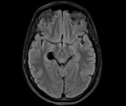 Choroid fissure cyst | Image | Radiopaedia.org