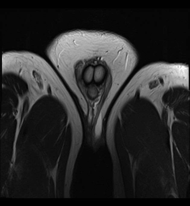 Fibrous Pseudotumor Of The Scrotum Image