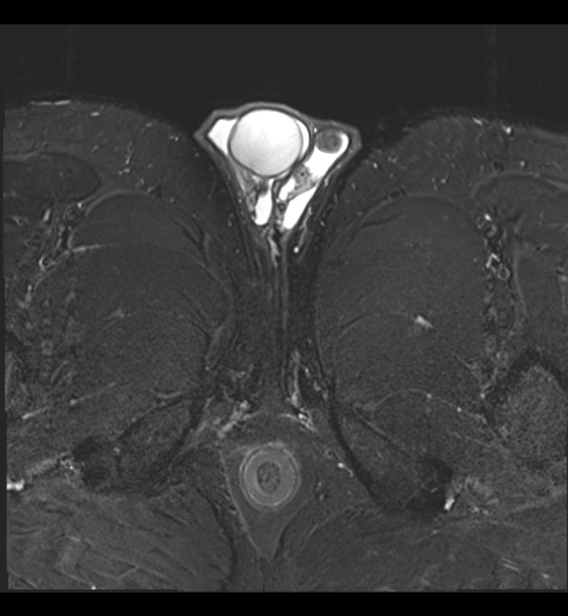 Fibrous pseudotumor of the scrotum | Image | Radiopaedia.org