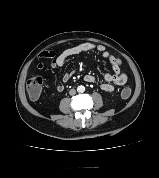 Mucinous Adenocarcinoma Of The Colon Splenic Flexure Image 8120