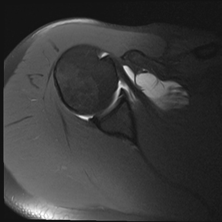 Perthes lesion | Radiology Reference Article | Radiopaedia.org