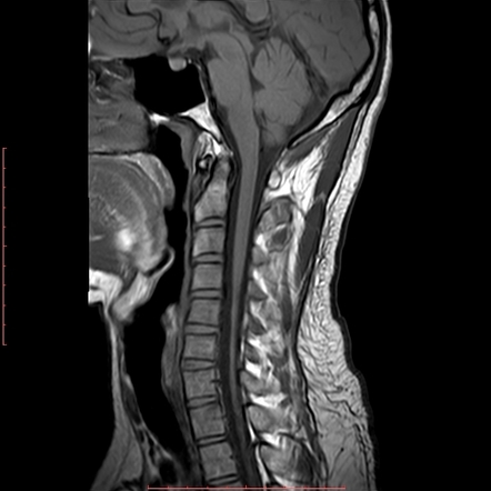 Hirayama disease | Image | Radiopaedia.org