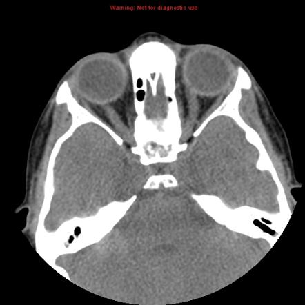 Immotile cilia syndrome | Image | Radiopaedia.org