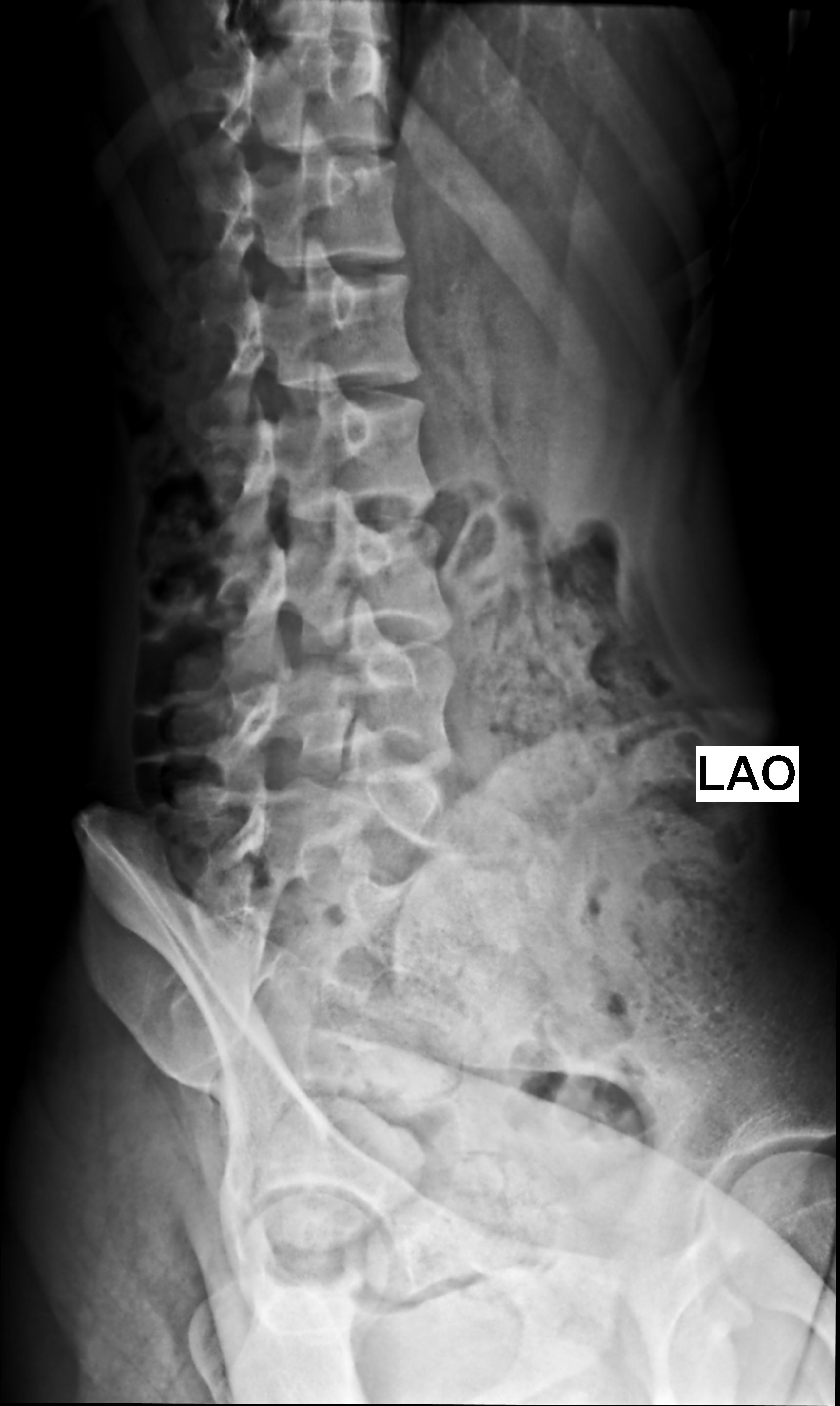 Pars Interarticularis Fracture Image 7738