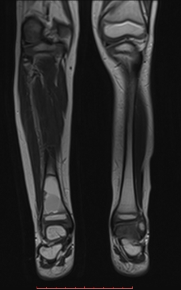 Bone cyst | Image | Radiopaedia.org