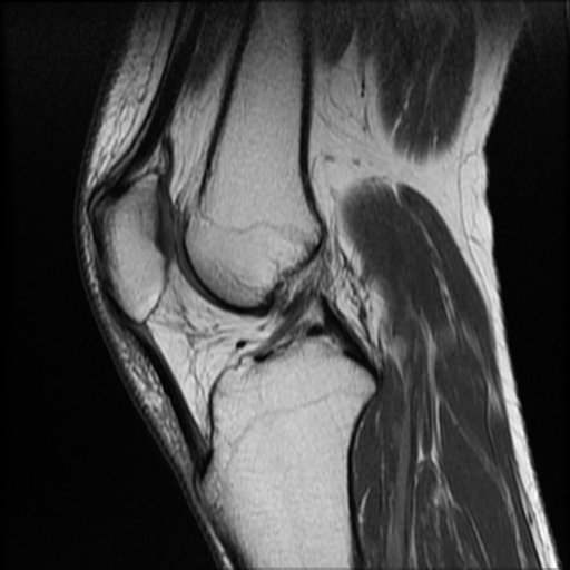 Lobulated ganglion cyst - knee | Image | Radiopaedia.org