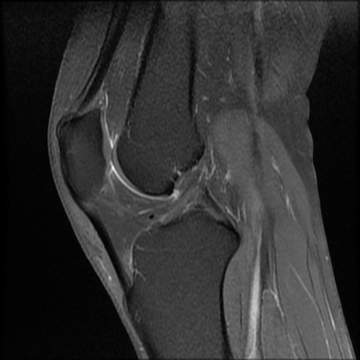 Lobulated ganglion cyst - knee | Image | Radiopaedia.org