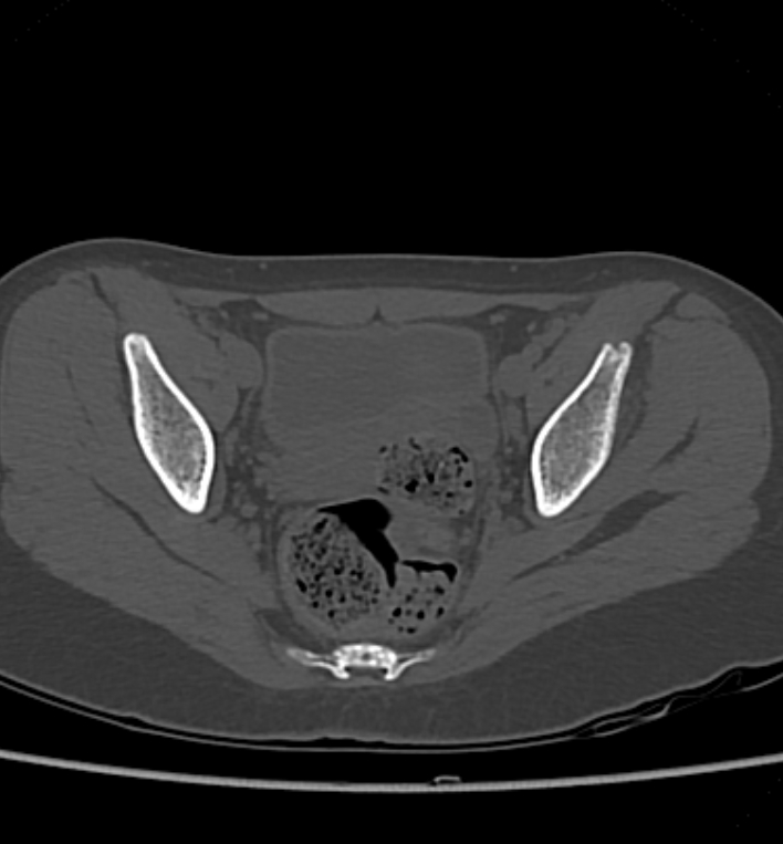 Slipped upper femoral epiphysis | Image | Radiopaedia.org