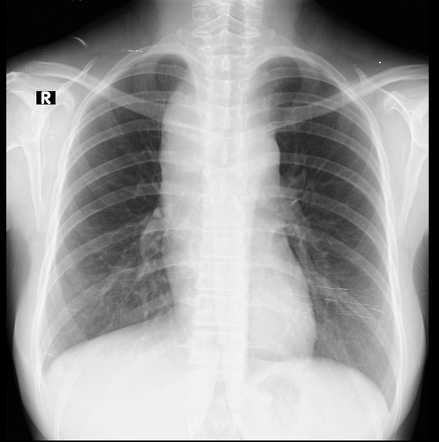 Medistinal lymphoma | Radiology Case | Radiopaedia.org