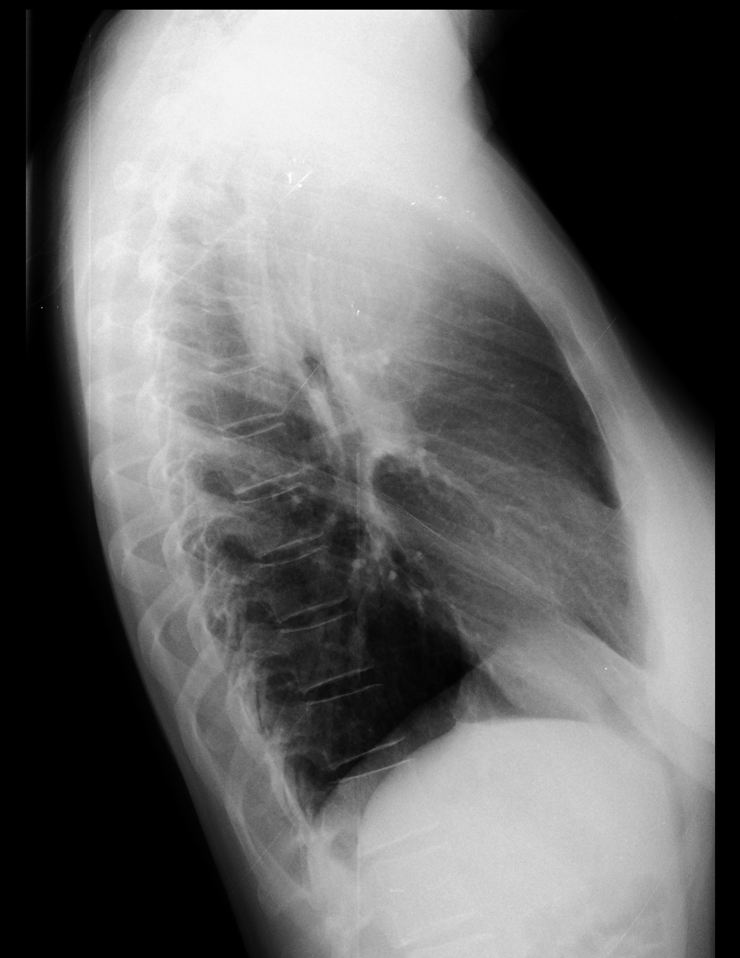 Medistinal lymphoma | Image | Radiopaedia.org