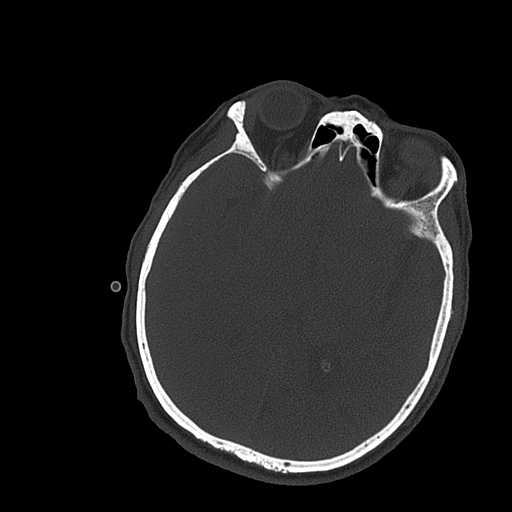 Subdural Empyema Image