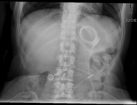 Slipped gastric band | Radiology Case | Radiopaedia.org