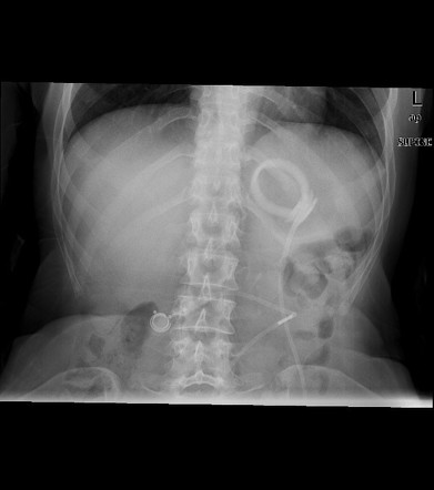 Slipped gastric band | Radiology Case | Radiopaedia.org