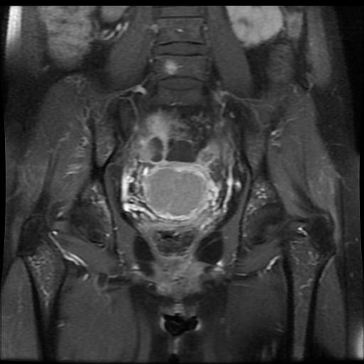 Endometrioid adenocarcinoma of the endometrium | Image | Radiopaedia.org