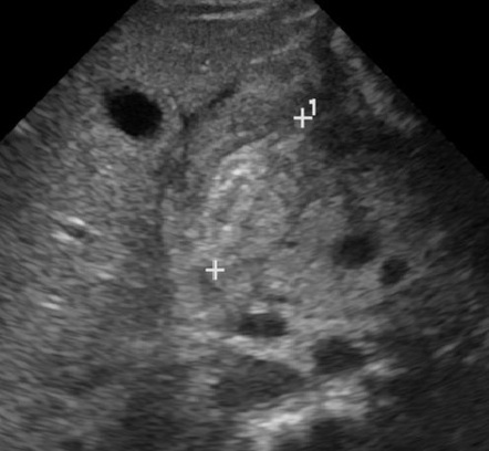 Pyloric Stenosis Radiology Case Radiopaedia Org