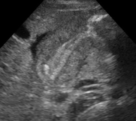 Pyloric Stenosis Image Radiopaedia Org   996e6b8ed288973a231f95342a392b Gallery 