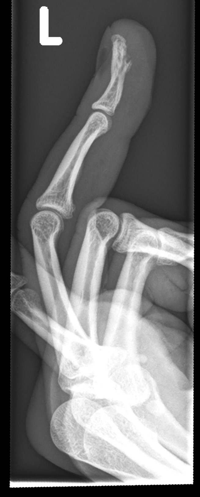 Distal phalanx tuft fracture | Image | Radiopaedia.org