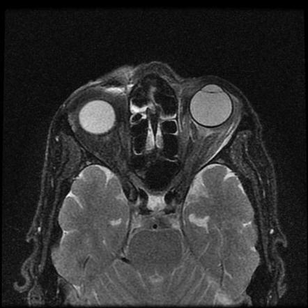 Orbital lymphoma | Image | Radiopaedia.org