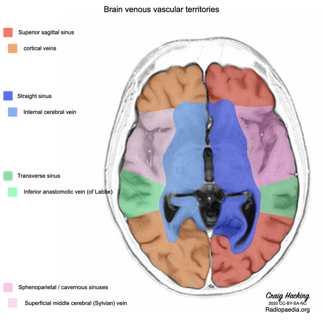 Venous vascular territories of the lateral cerebral cortex (illustration), Radiology Case