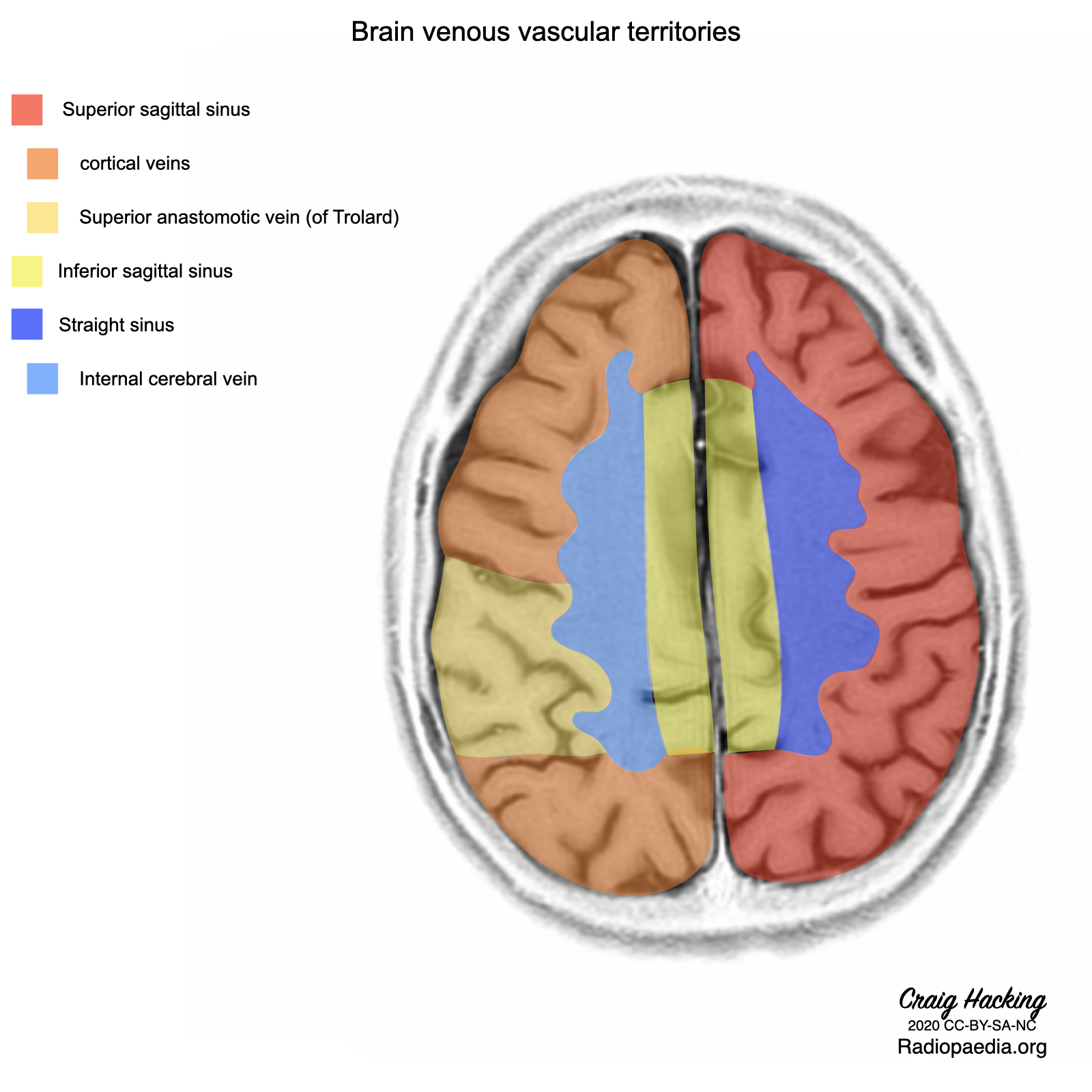 Venous vascular territories of the lateral cerebral cortex (illustration), Radiology Case