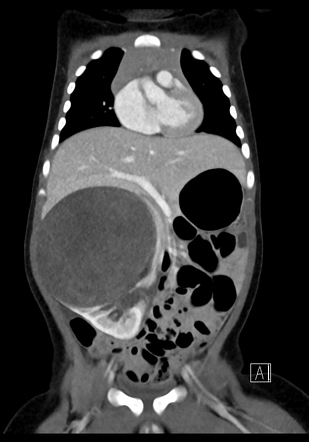 Claw sign (mass) | Radiology Reference Article | Radiopaedia.org