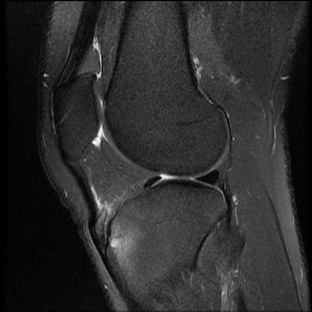 Osgood-Schlatter disease | Radiology Case | Radiopaedia.org