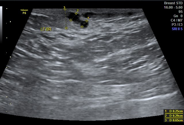 Mondor Disease Breast Image