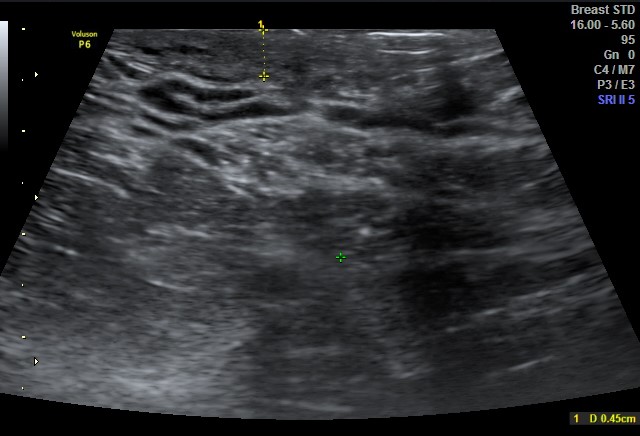 Mondor disease - breast | Image | Radiopaedia.org