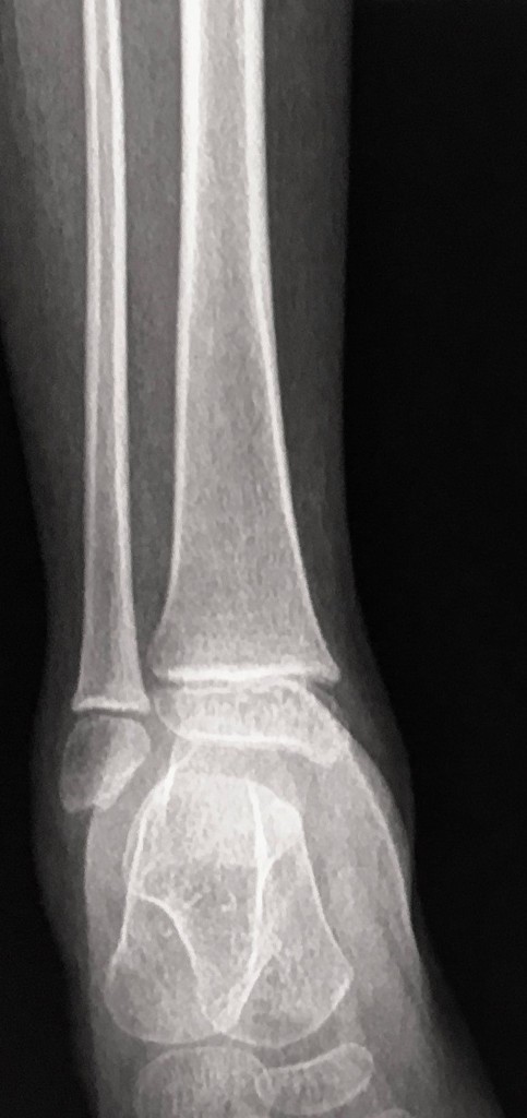 Equinus Foot Deformity Radiology Case Radiopaedia Org