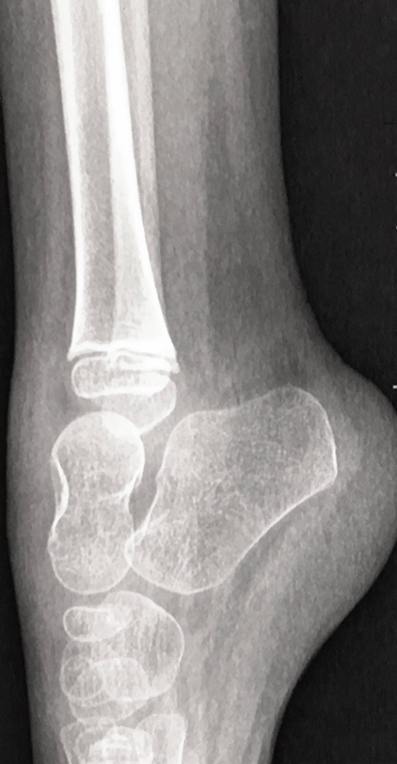 Equinus foot deformity | Image | Radiopaedia.org