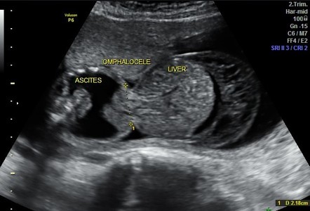 Omphalocele | Radiology Reference Article | Radiopaedia.org