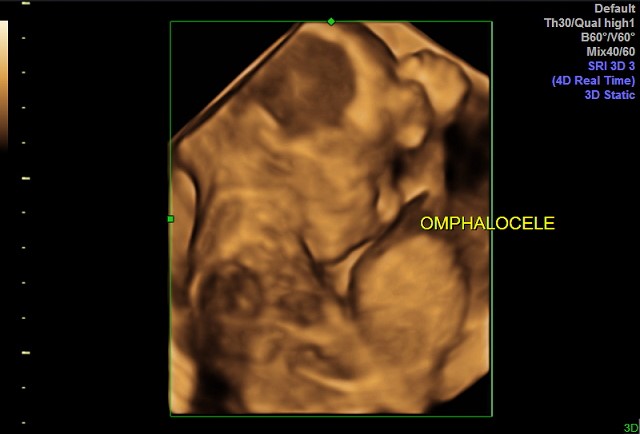 Omphalocele | Image | Radiopaedia.org