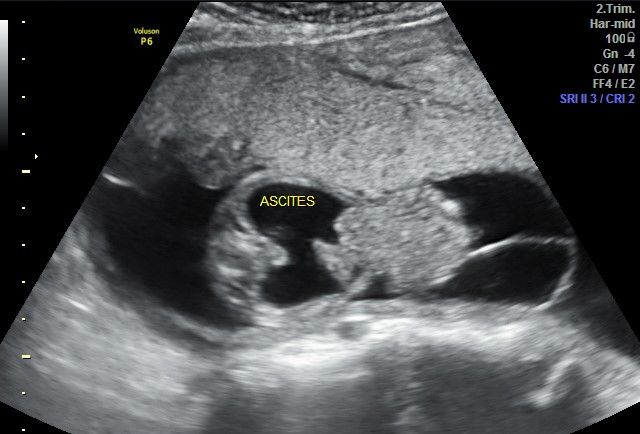 Omphalocele | Image | Radiopaedia.org