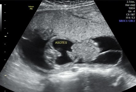 Omphalocele Ultrasound