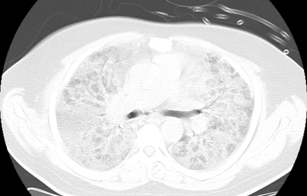 COVID-19 pneumonia | Radiology Case | Radiopaedia.org