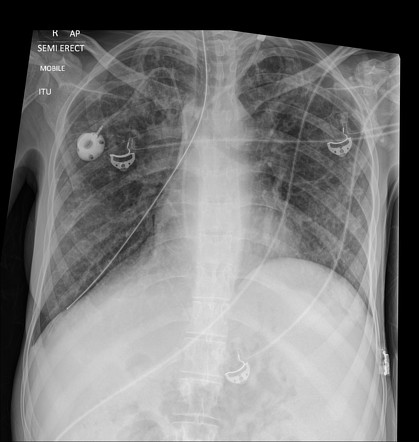 Nasogastric tube in the right lower lobe | Radiology Case | Radiopaedia.org