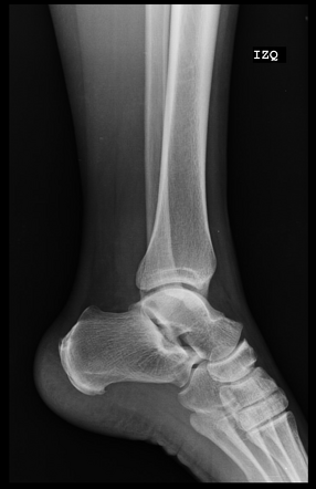 Haglund Deformity Radiology Case Radiopaedia Org