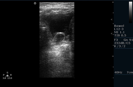 Ureterocele | Radiology Case | Radiopaedia.org