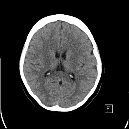 Vein of Trolard thrombosis with venous infarction (CT perfusion ...