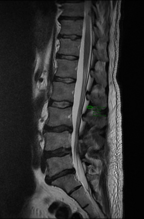 Foraminal disc prolapse | Image | Radiopaedia.org