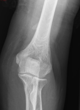 Supracondylar spur | Radiology Case | Radiopaedia.org