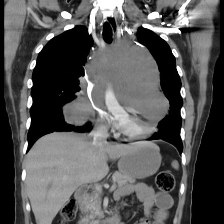 Mediastinal Germ Cell Tumor | Image | Radiopaedia.org