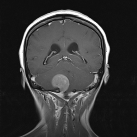 Meningeal melanocytoma | Image | Radiopaedia.org