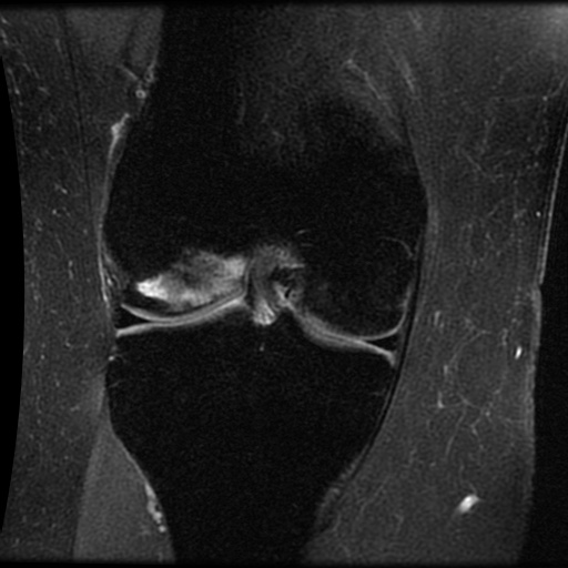 Iron overload (MRI knee) | Image | Radiopaedia.org