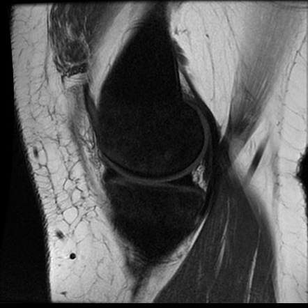 Iron overload (MRI knee) | Radiology Case | Radiopaedia.org