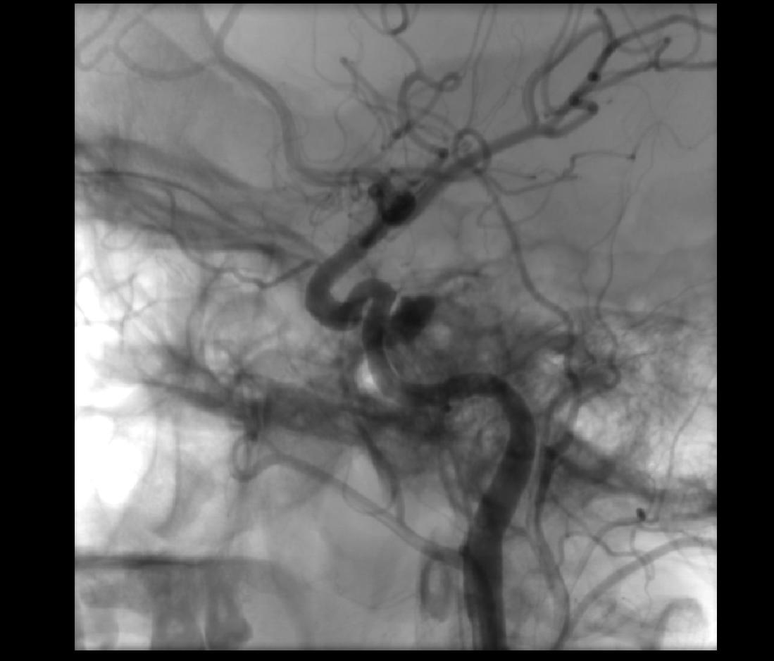 Traumatic internal carotid artery pseudoaneurysm | Image | Radiopaedia.org